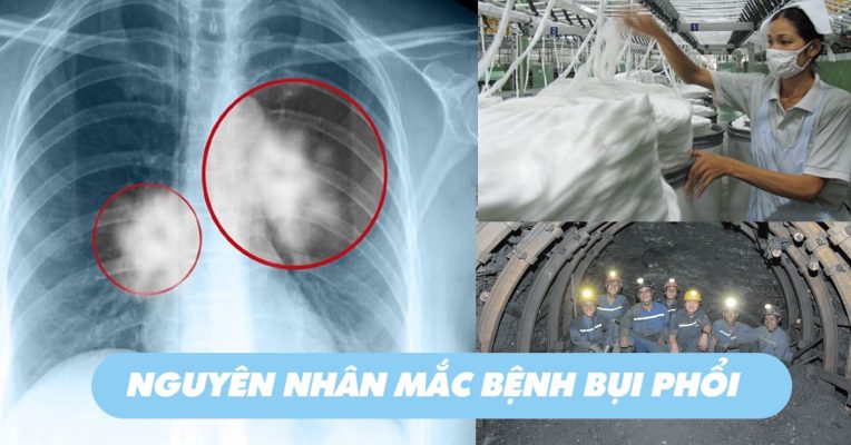 bec-phun-dap-bui-nganh-det